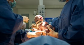 Baby being born via Caesarean Section Baby being born via Caesarean Section